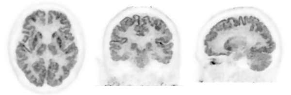 Photos: FDG-PET Images of Brain (Courtesy of Institute of Advanced Clinical Medicine, Kindai University Hospital)