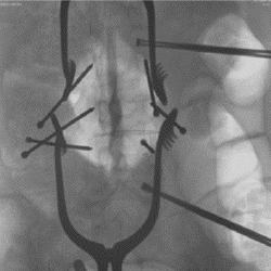 Streamline procedures