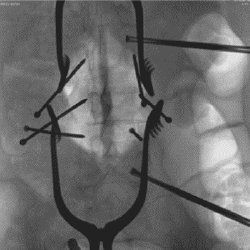 Streamline procedures