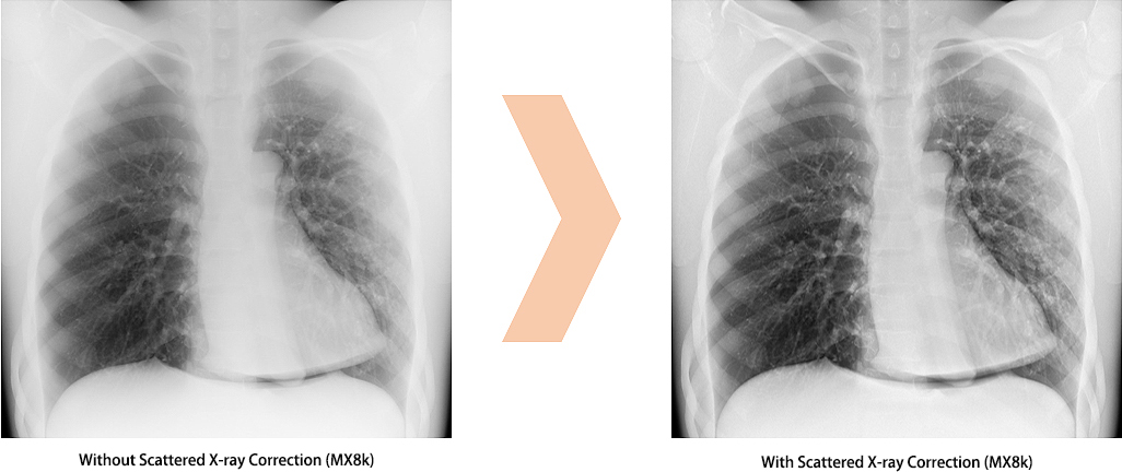 Scattered X-ray Correction Enables Grid-less Radiography