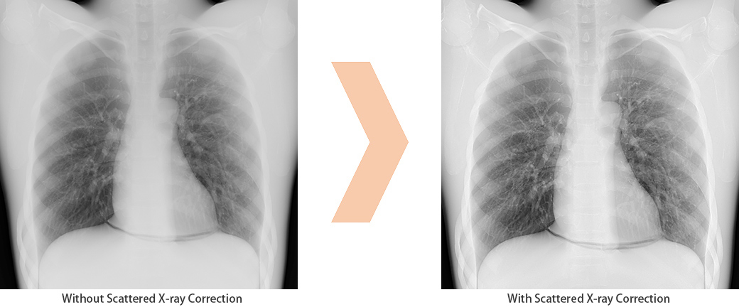 Scattered X-ray Correction Enables Grid-less Radiography