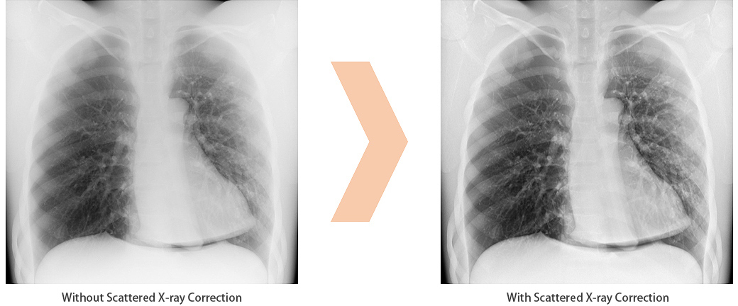 Scattered X-ray Correction Enables Grid-less Radiography