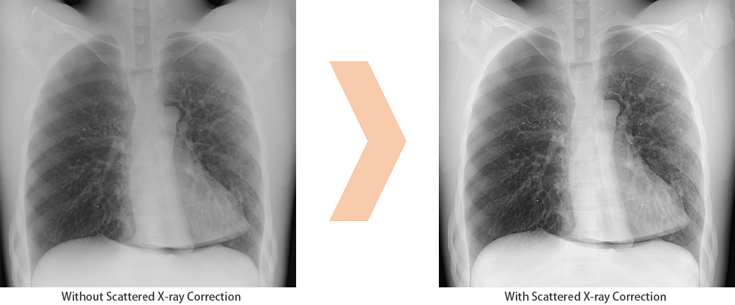 Scattered X-ray Correction Enables Grid-less Radiography